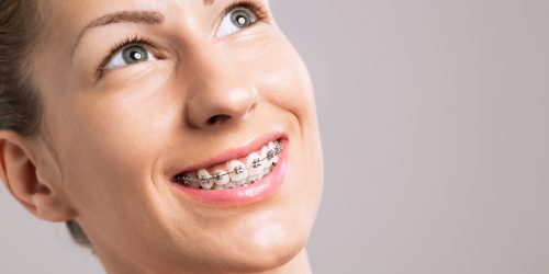 Braces Teeth Female Smile on gray background